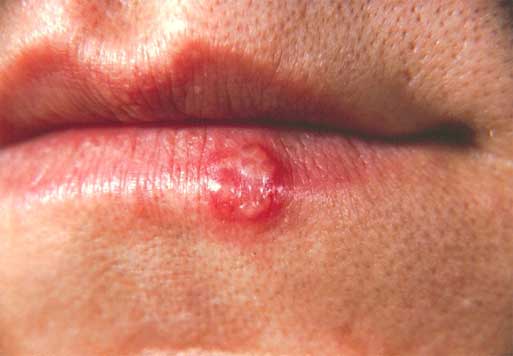 herpes pictures. Herpes In Mouth Symptoms