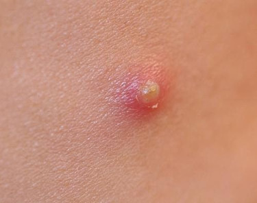 Little Red Bumps On Skin That Look Like Pimples - Doctor ...