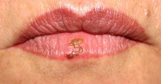 herpes mouth pictures. Mouth sore caused by herpes