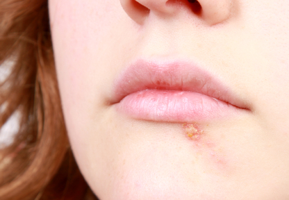 Causes Of Blood Blisters In The Mouth | Bad Mouths