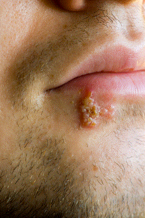 herpes blister on the lips