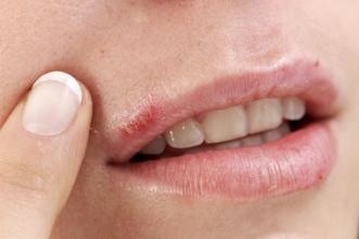 Cold Sore Image of Herpes
