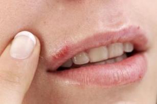 Picture of Cold Sore