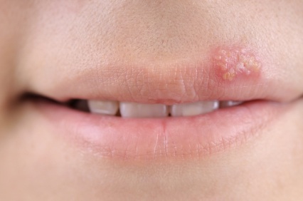 oral herpes on the lips