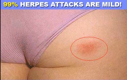 What Does Herpes Look Like Before An Outbreak?