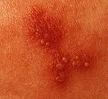 symptons of herpes