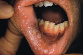 genital herpes inside mouth
