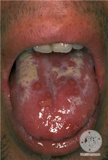 herpes on your tongue
