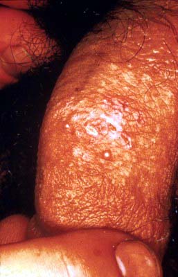 Male Herpes Symptoms
