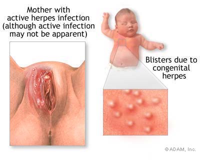 neonatal herpes