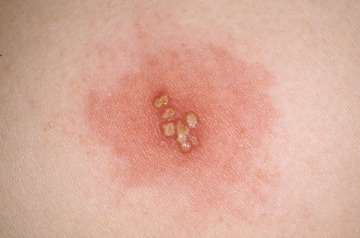 Images of Herpes Outbreaks