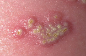 picture of herpes outbreak