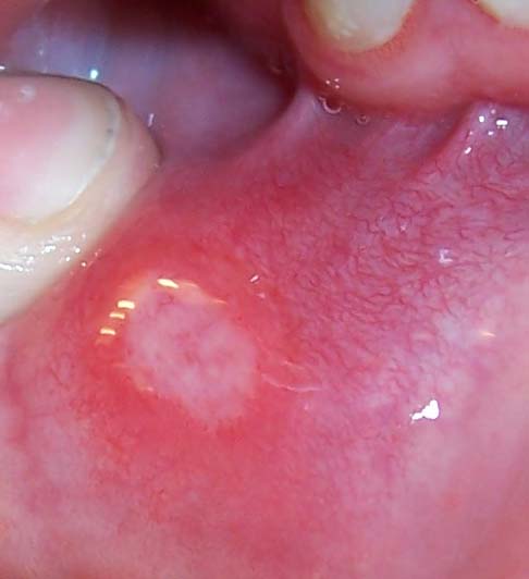Herpes Symptom Mouth
