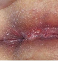Female Genital Herpes Photo