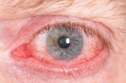 Ocular Herpes
