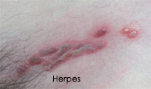 outbreak of herpes picture